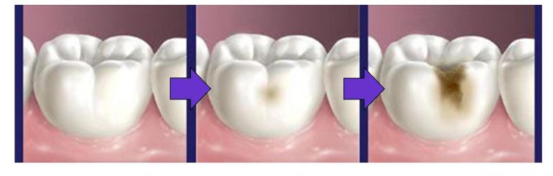 蛀牙是指牙齒遭受細菌破壞，由牙齒外層的琺瑯質開始，逐漸擴展至牙齒的深層組織